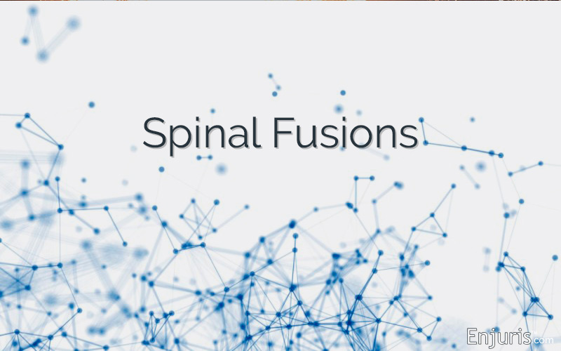 Spinal Fusions