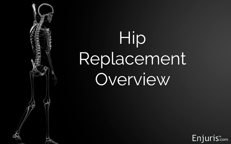 Hip Replacement Overview